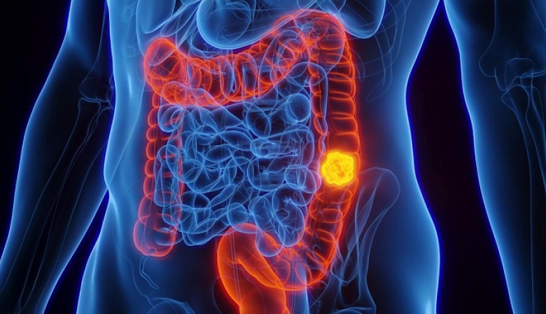 Cáncer de Colon: diagnóstico temprano y hábitos saludables para reducir el riesgo