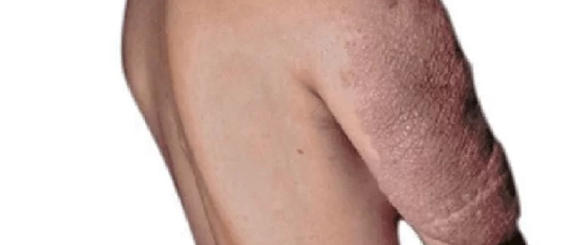 Neurofibromatosis: la enfermedad poco frecuente que exige diagnóstico temprano