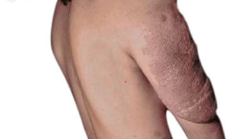Neurofibromatosis: la enfermedad poco frecuente que exige diagnóstico temprano