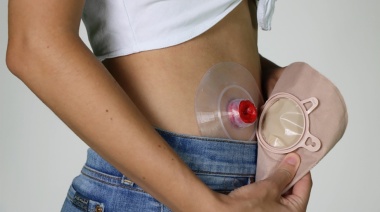 ¿Qué es la ostomía? El tabú del que poco se habla