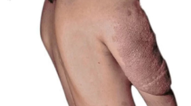 Neurofibromatosis: la enfermedad poco frecuente que exige diagnóstico temprano