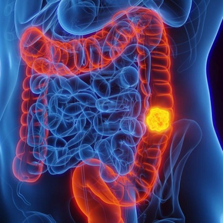 Cáncer de Colon: diagnóstico temprano y hábitos saludables para reducir el riesgo