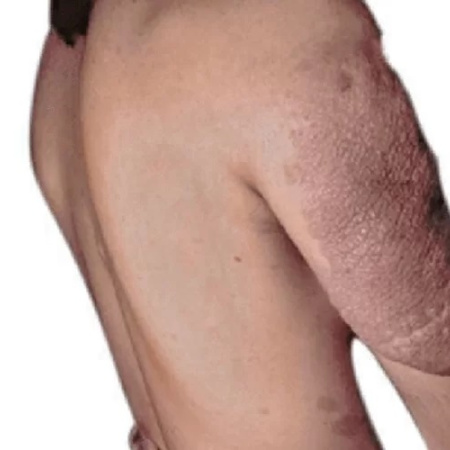Neurofibromatosis: la enfermedad poco frecuente que exige diagnóstico temprano